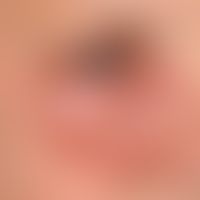 Herpes-simplex-Virus-Infektion: herpetiforme, disseminierte kleine Pusteln auf geröteter Haut, pe...