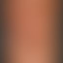 Lipoatrophie, lokalisierte nach Glukokortikosteroid-Injektionen. Übersichtsaufnahme: 2,5 x 3,0 cm...