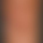 Lipoatrophie, lokalisierte nach Glukokortikosteroid-Injektionen. Übersichtsaufnahme: 2,5 x 3,0 cm...