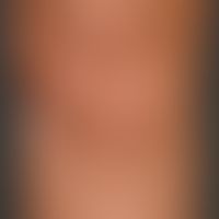 Lipoatrophie, lokalisierte nach Glukokortikosteroid-Injektionen: 2,5 x 3,0 cm großes, kreisrundes...