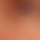 Syringome disseminierte: sehr diskrete, hautfarbene, völlig symptomlose, lediglich kosmetisch stö...