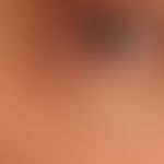Syringome disseminierte: sehr diskrete, hautfarbene, völlig symptomlose, lediglich kosmetisch stö...