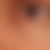Syringome disseminierte: sehr diskrete, hautfarbene, völlig symptomlose, lediglich kosmetisch stö...