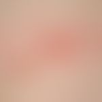 Zoster: Detailaufnahme. herpetiform gruppierte Bläschen auf geröteter Haut bei einem 3 Monate alt...