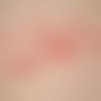 Zoster: Detailaufnahme. herpetiform gruppierte Bläschen auf geröteter Haut bei einem 3 Monate alt...