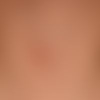 Late syphilis: asymmetrical, reddish-brown plaques, completely without symptoms.
