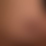 Late syphilis: with asymmetrical, reddish-brown, completely symptom-free plaques with crust forma...