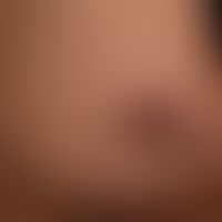 Late syphilis: with asymmetrical, reddish-brown, completely symptom-free plaques with crust forma...