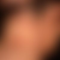 Chronische kontaktallergische Dermatitis des Capillitiums (s. diskretes, jedoch deutlich juckende...