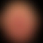 Squamous cell carcinoma in actinically damaged skin: Since more than 1 year, slowly growing, very...
