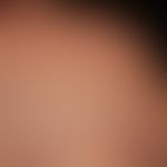 Squamous cell carcinoma in actinically damaged skin: Since a few months, slowly growing, very fir...