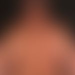Dermatosis, acute febrile neutrophils (Sweet Syndrome): suddenly appearing inflammatory, succulen...