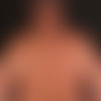 Dermatosis, acute febrile neutrophils (Sweet Syndrome): suddenly appearing inflammatory, succulen...