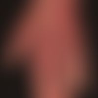 Erysipel: akut aufgetretene, unscharf begrenzte, flächige Rötung und Schwellung; bekannte atopisc...
