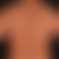 Nummular Dermatitis: General view: For several months persistent, strongly itching, solitary or c...