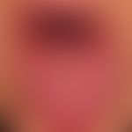 Lichen planus mucosae: severe, erosive, painful glossitis with reactive lingua plicata and whitis...