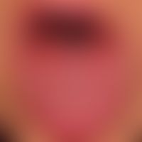 Lichen planus mucosae: severe, erosive, painful glossitis with reactive lingua plicata and whitis...