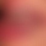 Lichen planus mucosae: severe, erosive painful glossitis with whitish, non-scrapeable coatings on...