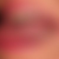 Lichen planus mucosae: severe, erosive painful glossitis with whitish, non-scrapeable coatings on...
