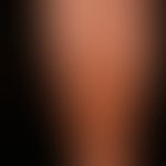 Purpura jaune d'ocre: multiple, chronisch stationäre, an den distalen Unterschenkeln lokalisierte...