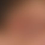 Kutanes T-Zell-Lymphom: seit Monaten bestehendes Plaqeu-und Knotenbildung bei vorbekannter Mycosi...