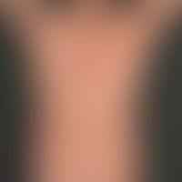 Kutanes T-Zell-Lymphom vom Typ der Mycosis fungoides: seit Jahren bestehendes, initial als "Parap...