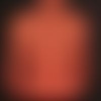 Sezary-Syndrom: erythrodermische "leukämische" Mycosis fungoides.
