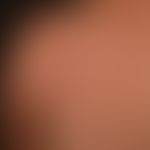 Pseudolymphoma of the skin: non-itchy, surface-smooth, reddish-brown papules and plaques on the l...