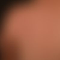 Pseudolymphoma of the skin: non-itchy, surface-smooth, reddish-brown papules and plaques on the l...