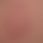 Pseudolymphoma of the skin: non-itchy, surface-smooth, reddish-brown papules and plaques on the l...