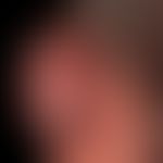 Basal cell carcinoma nodular: Nodule existing for several years, completely without symptoms, siz...
