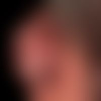 Basal cell carcinoma nodular: Nodule existing for several years, completely without symptoms, siz...