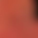 Lidschwellung: Massives Lidödem mit komplettem Lidverschluss. Akute kontaktallergische Dermatitis...