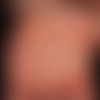 Epidermolysis bullosa simpex, Weber-Cockayne: after banal traumas visible blistering or only simp...