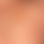 Mastocytosis: Cutaneous, diffuse mastocytosis with flat "peau d`orange and partly water clear, pa...