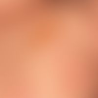 Mastocytosis: Cutaneous, diffuse mastocytosis with flat "peau d`orange and partly water clear, pa...