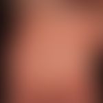 Bubbles in Epidermolysis bullosa simpex, Weber-Cockayne: after banal traumas visible blistering o...