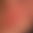 Eccema symmetricum faciale:&nbsp; Zugrunde liegende atopische Dermatitis , sog.&nbsp;"Tachau Bäck...