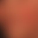 Erythema infectiosum: bei mäßigem Krankheitgefühl auftretende flächenhafte, schmetterlingsförmige...
