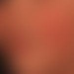 Erythema infectiosum: in cases of moderate feeling of illness, flat, butterfly-shaped redness and...