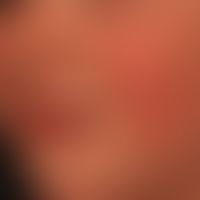 Erythema infectiosum: in cases of moderate feeling of illness, flat, butterfly-shaped redness and...