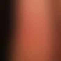 Anular erythema: Erythema infectiosum, butterfly-shaped redness and swelling of the cheeks in pat...