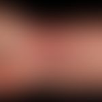 Erythema nodosum (Befall der oberen und unteren Extremitäten):&nbsp;akute, multiple inflammatoris...
