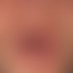 Stevens-Johnson-Syndrom: akut aufgetretene, großflächige, schmerzhafte Erosionen an Lippenrot, an...