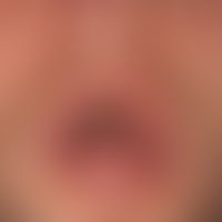 Stevens-Johnson-Syndrom: akut aufgetretene, großflächige, schmerzhafte Erosionen an Lippenrot, an...
