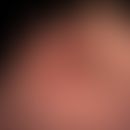 Parasitose der Haut: gramnegativer Fußinfekt mit massivem Befall mit Fliegenmaden.
