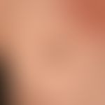 Melanom malignes superfiziell spreitendes: Außergewöhnliche großes, 6,0x4,0 cm durchmessendes, ma...