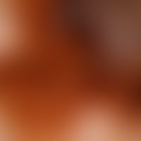 Melanom superfiziell spreitendes: außergewöhnliche großes, 6,0x4,0 cm durchmessendes, malignes Me...