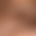 Melanoma malignes, nodular: A solitary node that has existed for years, has been growing for more...