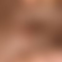 Melanoma malignes, nodular: A solitary node that has existed for years, has been growing for more...